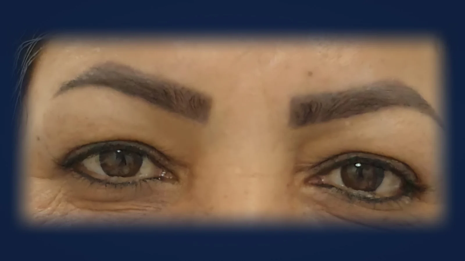 قبل: جراحی پلک بالا