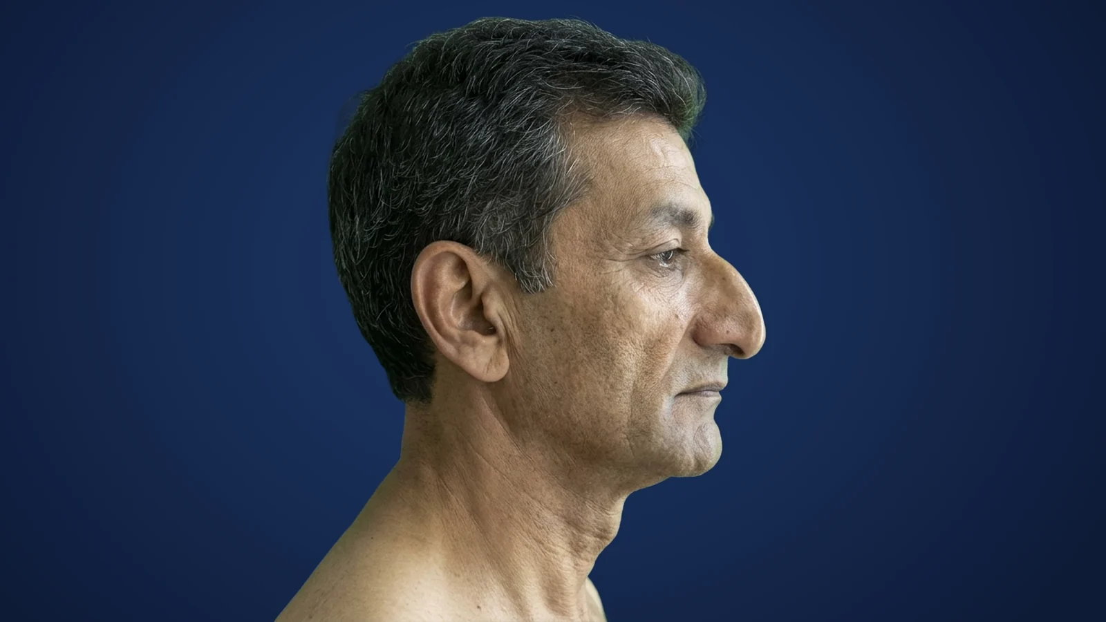 قبل: جراحی بینی مردانه